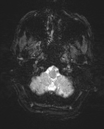 Bifrontal leucotomy (Radiopaedia 36798-38385 Axial SWI 6).png