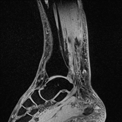 Bilateral Achilles tendon complete tear (Radiopaedia 81344-95051 Sagittal WE - Right 71).jpg