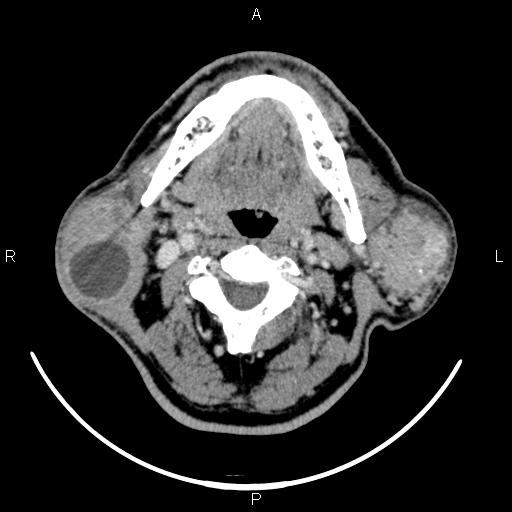 Bilateral Warthin tumors (Radiopaedia 84034-99263 Axial With contrast 28).jpg