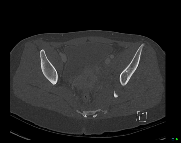 Bilateral acetabular fractures (Radiopaedia 79272-92308 Axial bone window 35).jpg