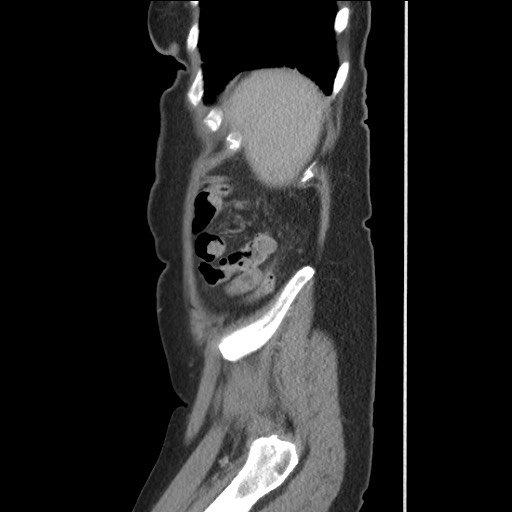 Bilateral adrenal granulocytic sarcomas (chloromas) (Radiopaedia 78375-91007 C 117).jpg