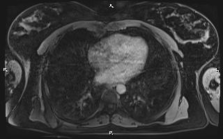 Bilateral adrenal myelolipoma (Radiopaedia 63058-71537 H 3).jpg