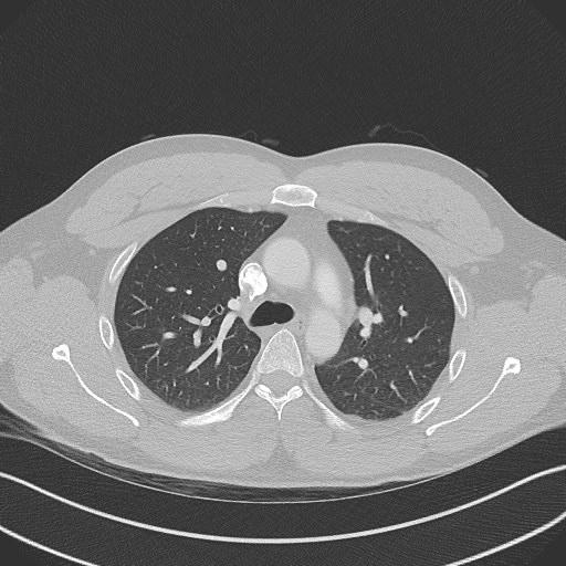 Bilateral atelectasis (Radiopaedia 48666-53675 Axial lung window 39).jpg