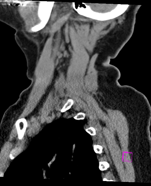 Bilateral atlanto-occipital assimilation (Radiopaedia 28350-28603 D 66).jpg