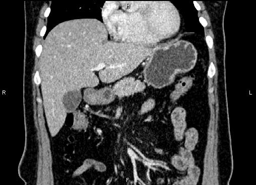 Bilateral benign adrenal adenomas (Radiopaedia 86912-103124 D 17).jpg