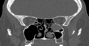 File:Bilateral ectopic infraorbital nerves (Radiopaedia 49006-54084 Coronal 20).png
