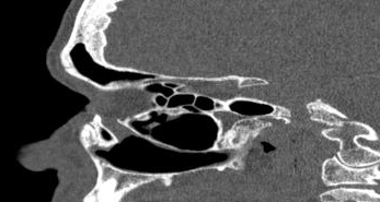 File:Bilateral ectopic infraorbital nerves (Radiopaedia 49006-54084 Sagittal 14).png