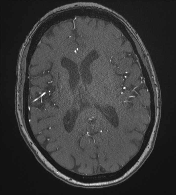 Bilateral fetal posterior communicating arteries (Radiopaedia 41286-44102 Axial MRA 126).png