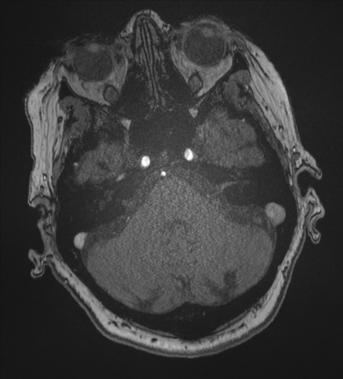 Bilateral fetal posterior communicating arteries (Radiopaedia 41286-44102 Axial MRA 41).png