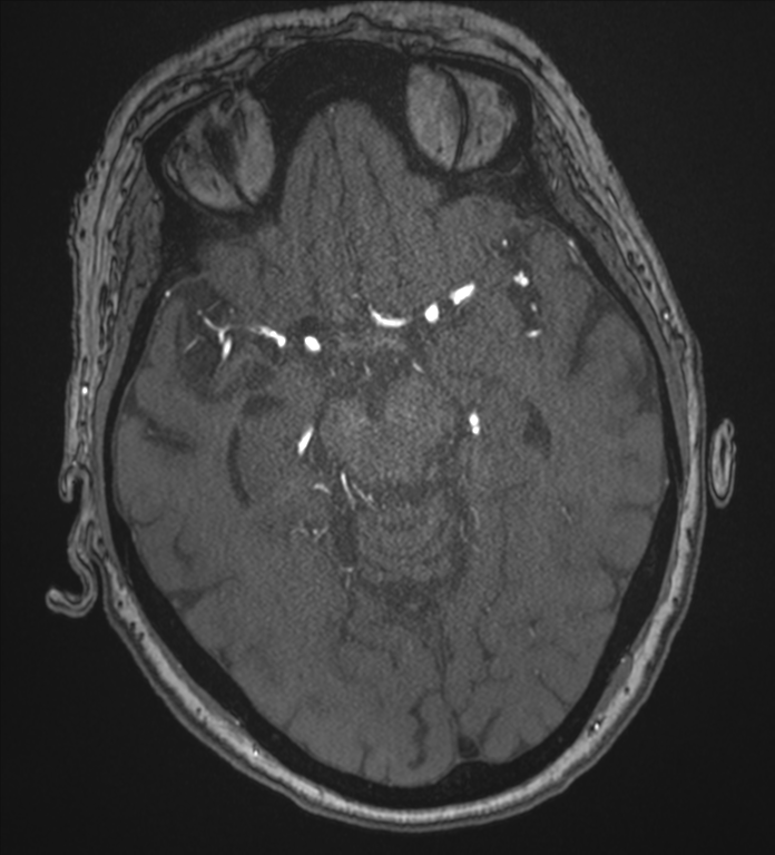 Bilateral fetal posterior communicating arteries (Radiopaedia 41286-44102 Axial MRA 85).png