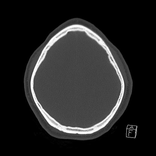 Bilateral occipital condyle fracture (type 2) (Radiopaedia 87675-104089 Axial bone window 108).jpg