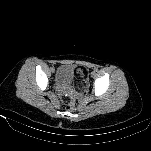 File:Bilateral ovarian dermoid (Radiopaedia 45714-49907 Axial non-contrast 30).JPEG
