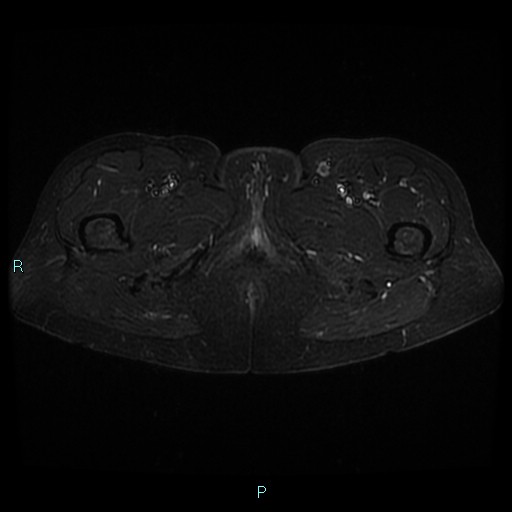 File:Bilateral ovarian fibroma (Radiopaedia 44568-48293 Axial STIR 32).jpg