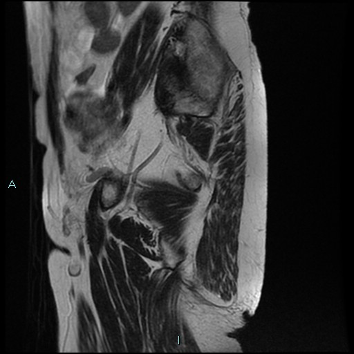 File:Bilateral ovarian fibroma (Radiopaedia 44568-48293 Sagittal T2 6).jpg