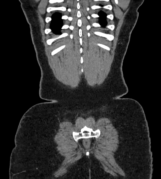 Bilateral ovarian mature cystic teratomas (Radiopaedia 79373-92457 B 105).jpg