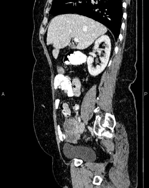 Bilateral ovarian serous cystadenocarcinoma (Radiopaedia 86062-101989 E 26).jpg