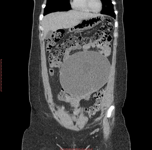File:Bilateral ovarian serous cystadenocarcinoma with right ovarian torsion (Radiopaedia 32640-33611 B 8).jpg
