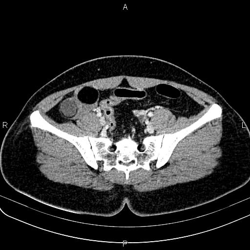 Bilateral ovarian teratoma (Radiopaedia 83131-97503 Axial With contrast 27).jpg