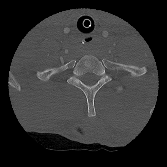 Bilateral perched facets with cord injury (Radiopaedia 45587-49713 Axial bone window 94).jpg