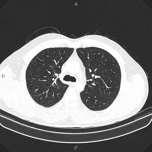 File:Bilateral pulmonary AVM (Radiopaedia 83134-97505 Axial lung window 26).jpg