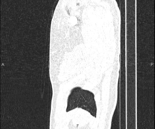 Bilateral pulmonary AVM (Radiopaedia 83134-97505 Sagittal lung window 17).jpg