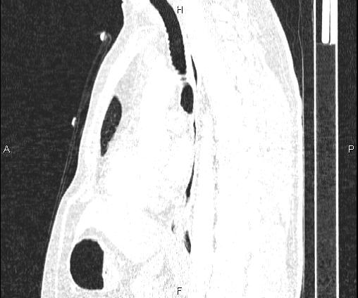 Bilateral pulmonary AVM (Radiopaedia 83134-97505 Sagittal lung window 62).jpg