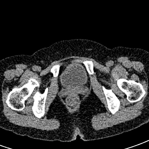 Bilateral staghorn calculi (Radiopaedia 59475-66842 Axial non-contrast 86).jpg