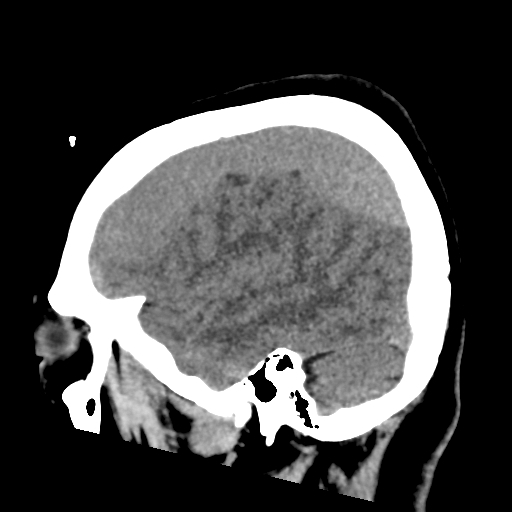 File:Bilateral subacute subdural hematoma (Radiopaedia 69240-79018 C 11).jpg