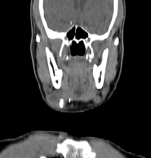 Bilateral submandibular sialolithiasis with sialadenitis (Radiopaedia 70721-80881 Coronal non-contrast 15).jpg