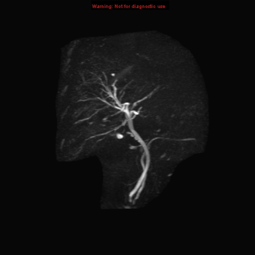 File:Biliary tree anatomical variant - biliary trifurcation (Radiopaedia 12531-12750 Coronal 3D MRCP 14).jpg
