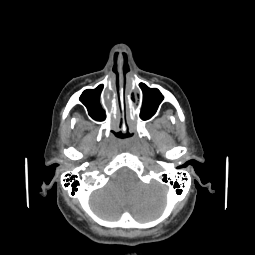 File:Bisphosphonate-related osteonecrosis of the jaw (Radiopaedia 71324-81642 non-contrast 141).jpg