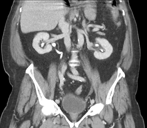 File:Bladder papillary urothelial carcinoma (Radiopaedia 48119-52951 C 39).png