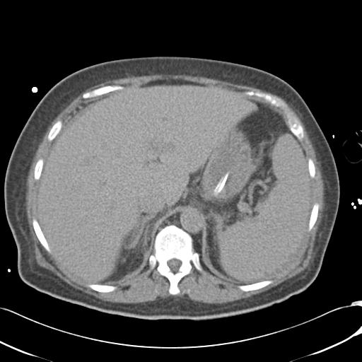 Bladder rupture post renal biopsy (Radiopaedia 30863-31572 Axial non-contrast 21).jpg