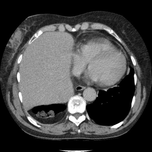 Bladder tumor detected on trauma CT (Radiopaedia 51809-57609 C 15).jpg