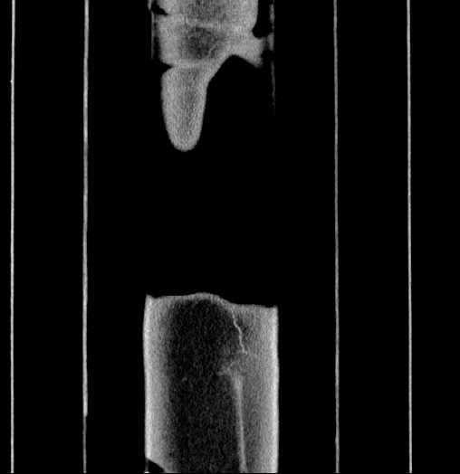 Blind-ending branch of a bifid ureter (Radiopaedia 61159-69048 C 74).jpg