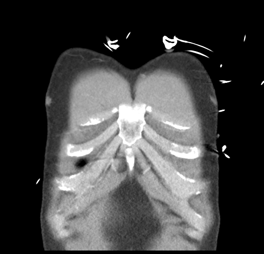 File:Boerhaave syndrome (Radiopaedia 39382-41661 B 8).png