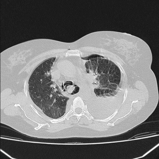 Boerhaave syndrome (Radiopaedia 45644-49799 Axial lung window 50).jpg