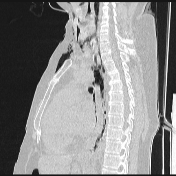Boerhaave syndrome (Radiopaedia 45644-49799 Sagittal lung window 42).jpg