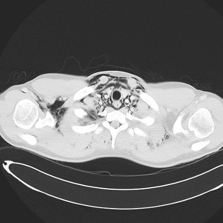 File:Boerhaave syndrome with mediastinal, axillary, neck and epidural free gas (Radiopaedia 41297-44115 Axial lung window 27).jpg