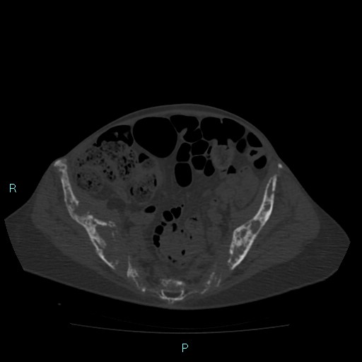 File:Bone metastases from untreated breast cancer (Radiopaedia 42973-46219 Axial bone window 160).jpg
