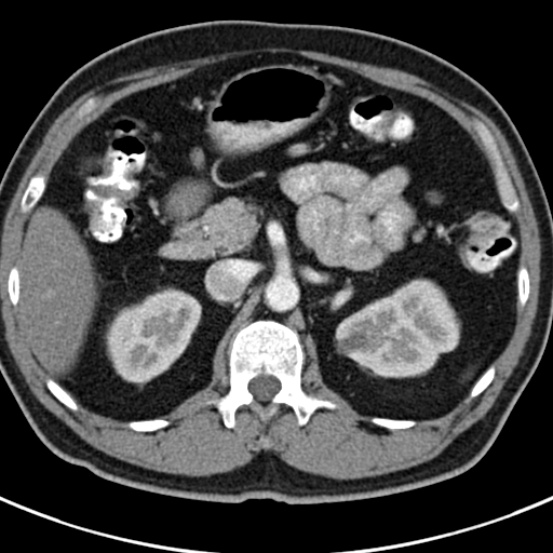 File:Bosniak cyst - type IV (Radiopaedia 23525-23627 renal cortical phase 15).jpg