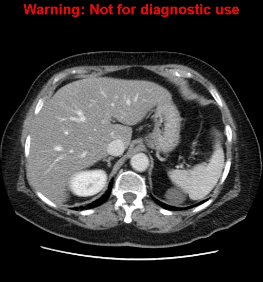 File:Bosniak renal cyst - type II (Radiopaedia 23404-23468 D 16).jpg