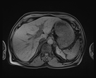 Bouveret syndrome (Radiopaedia 61017-68856 Axial T1 fat sat 20).jpg