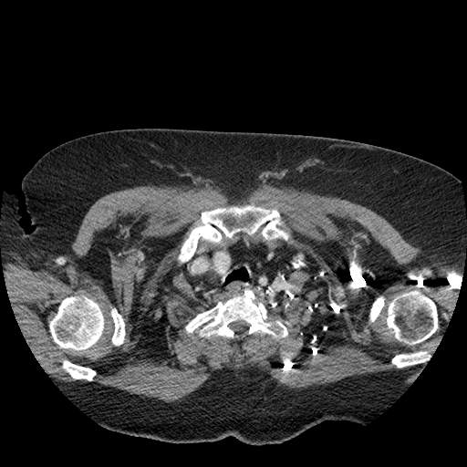 Bovine aortic arch - right internal mammary vein drains into the superior vena cava (Radiopaedia 63296-71875 A 9).jpg