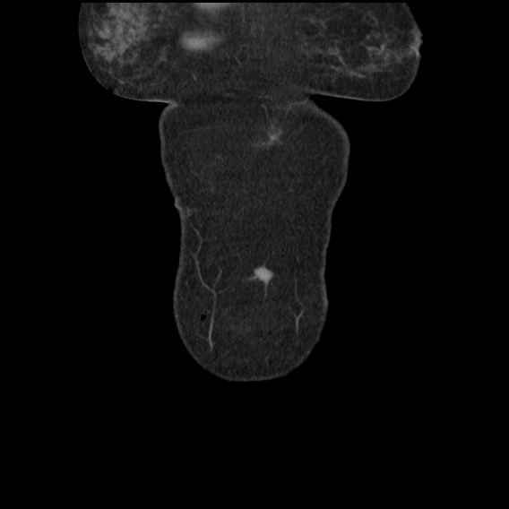 Bowel perforation at ERCP (Radiopaedia 59094-66394 A 6).jpg