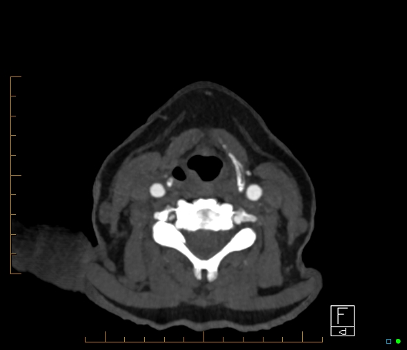 Brachiocephalic trunk stenosis (Radiopaedia 87242-103519 A 101).jpg
