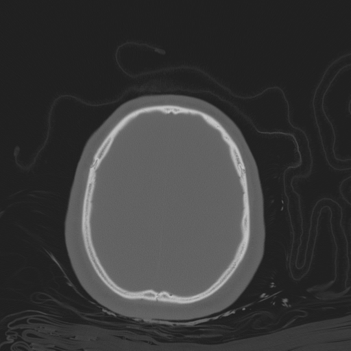 Brain contusions, internal carotid artery dissection and base of skull fracture (Radiopaedia 34089-35339 Axial bone window 98).png