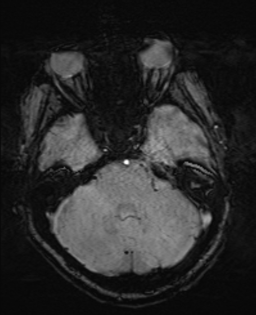 Brain metastases - lung cancer primary (Radiopaedia 75060-86115 Axial SWI 18).jpg