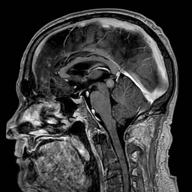 Brain metastases from lung cancer (Radiopaedia 83839-99028 Sagittal T1 C+ 32).jpg