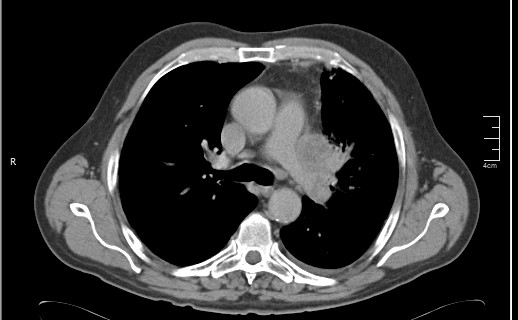 File:Brain metastases from squamocellular lung cancer (Radiopaedia 56515-63219 B 28).jpg